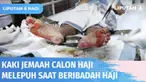 Sejumlah jemaah calon haji Indonesia mengalami kaki melepuh usai pulang dari ibadah di Masjid Nabawi. Cuaca panas yang mencapai 42 derajat celcius dan tidak menggunakan alas kaki jadi penyebab utama jemaah alami kaki melepuh.