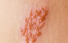 Mitos Dompo Alias Herpes Zoster yang Harus Diketahui, Simak Penyebabnya