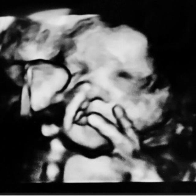 Foto Usg Bayi Lucu