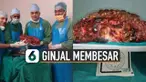 Dokter di India berhasil mengangkat ginjal seberat 7,4 kilogram. Pasien mengalami kelainan hingga ukuran ginjalnya membesar.