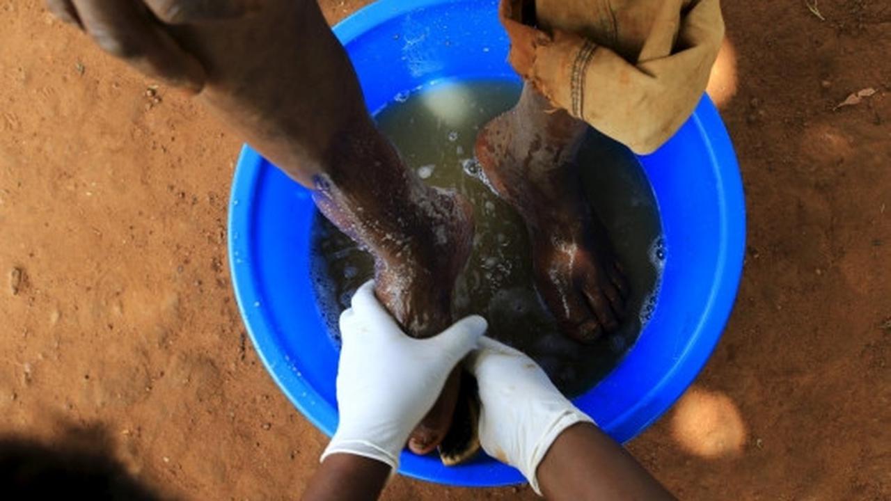 Derita warga Uganda terinfeksi kutu pengisap darah Jigger