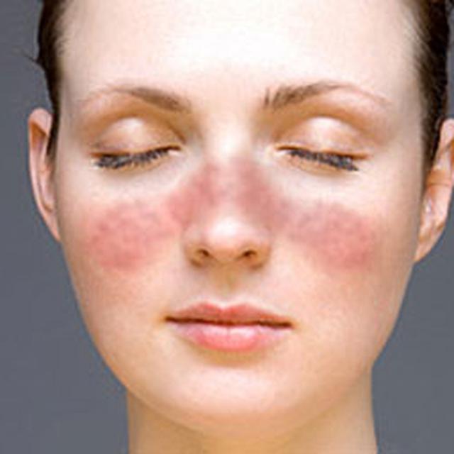 9 Tanda Lupus yang Tak Boleh Diabaikan Wanita - Health Liputan6.com