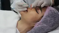 Prosedur tanam benang hidung di klinik kecantikan. (dok. PR)