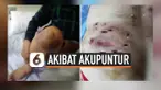 THUMBNAIL AKUPUNTUR