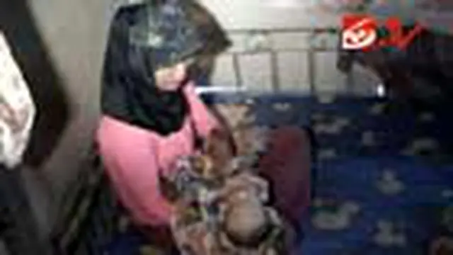 Bayi Penderita Gizi Buruk Meninggal Dunia