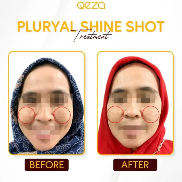 Treatment untuk Mengatasi Melasma atau Flek Hitam Bersama Qeza Aesthetic Clinic