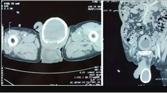 Kena Infeksi Cacing, Testis Pria Ini Kulitnya Mengeras Seperti Kulit Telur