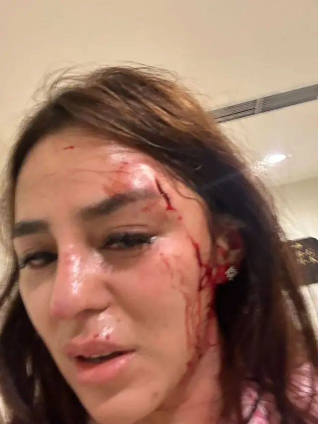 Selebgram Safa Marwah memerlihatkan bagian pelipis matanya yang berdarah (https://www.instagram.com/p/CxtwLGYhazR/)