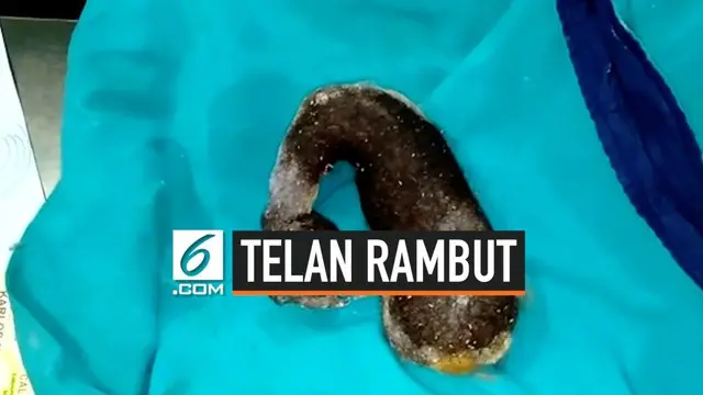 VIDEO: Dokter Keluarkan 1,5 Kg Gumpalan Rambut dari Perut Gadis Ini