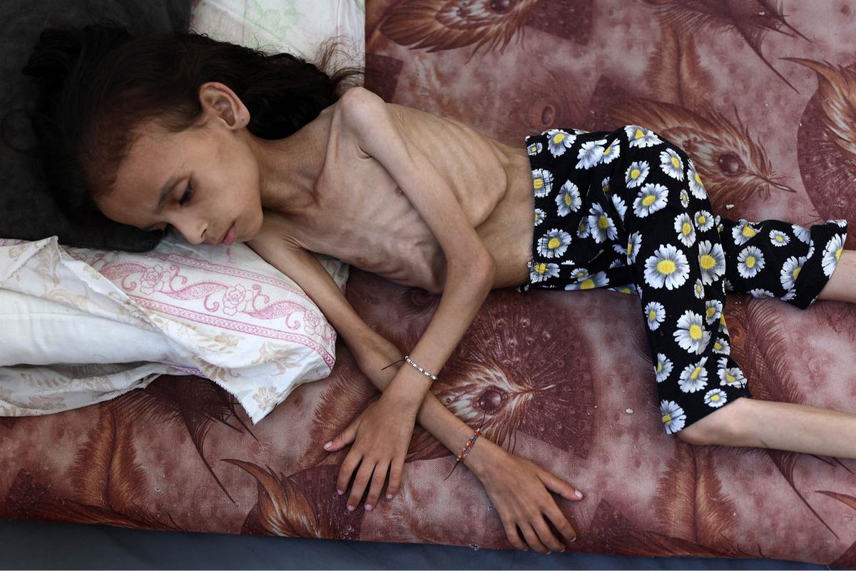 FOTO: Potret Pedih Mariam Anak 9 Tahun, Korban Kelaparan Gaza