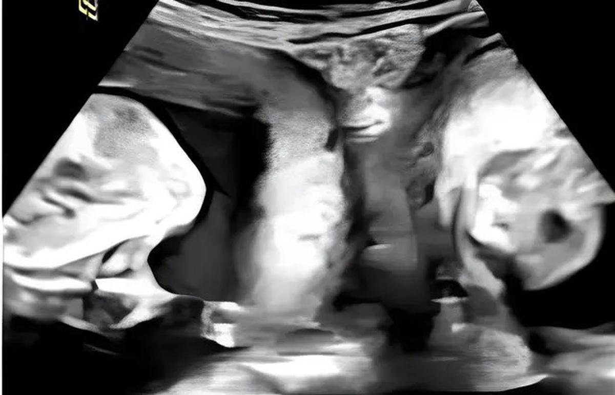 Kisah Wanita Punya Dua Rahim Masing-Masing Mengandung Bayi, Fenomena Langka