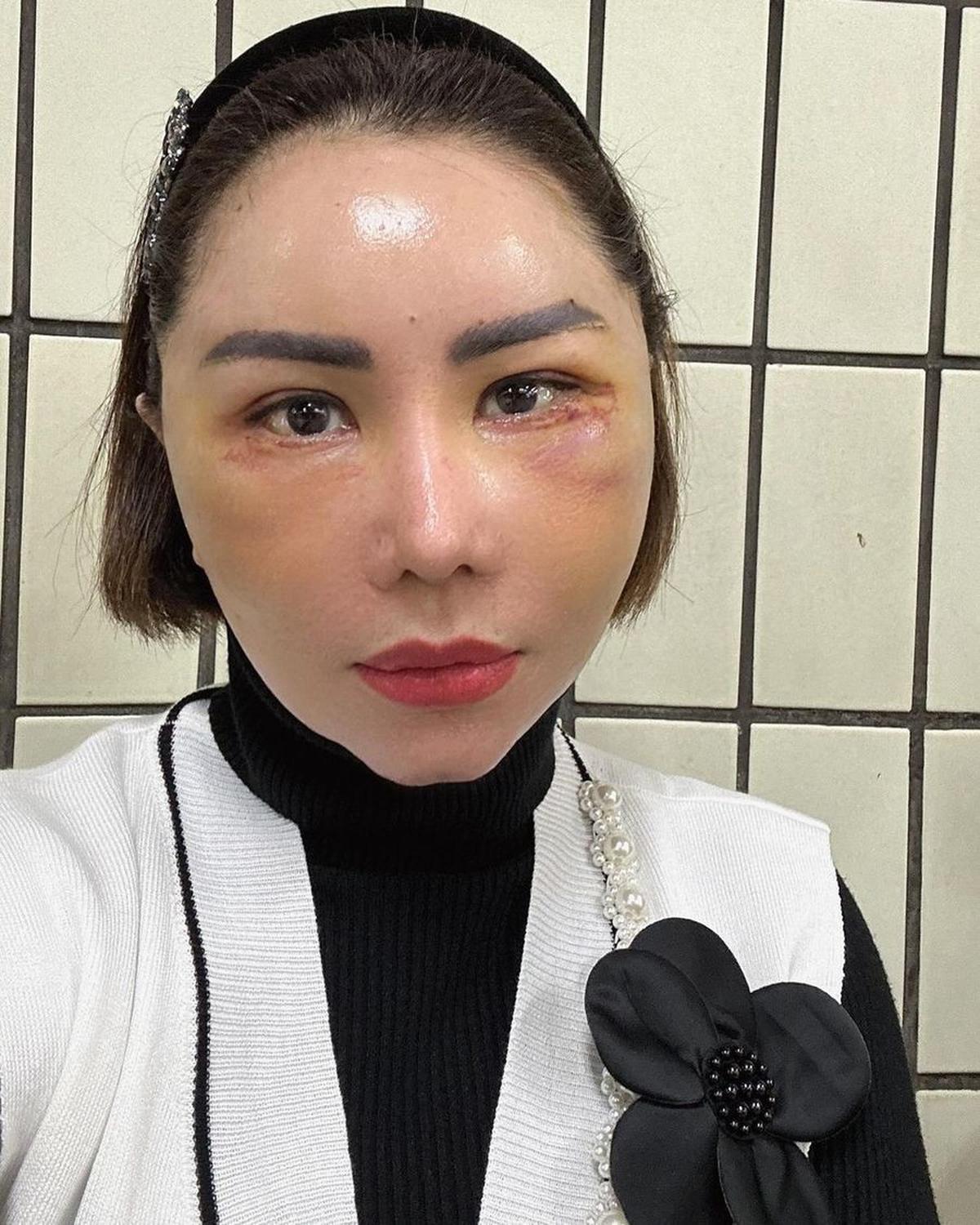 Potret Femmy Permatasari Setelah Oplas di Korea, Rela Wajah Bengkak dan 'Jelek' Dulu Pasca Lakukan 6 Prosedur Operasi