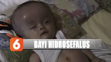 Bayi berumur 10 bulan di Nganjuk, Jawa Timur sejak di dalam kandungan menderita hidrosefalus.