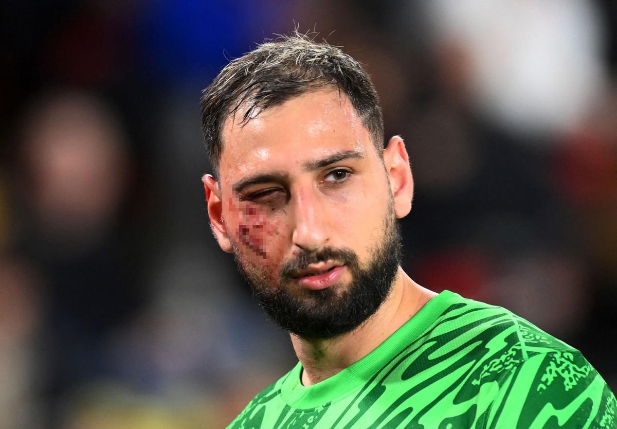 Wajah Donnarumma Berdarah-darah Usai Tendangan Horor Wilfried Singo