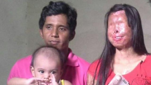 Hasil gambar untuk Kisah Nyata: Meskipun Wajah Kekasihnya Tak Sempurna, Pria Ini Masih Menyayanginya"