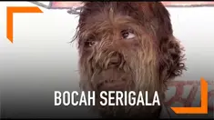 Lalit Patidar menderita penyakit bernama ‘Werewolf Syndrome’. Sebuah kondisi di mana wajah, dan anggota badannya ditumbuhi bulu lebat seperti binatang.