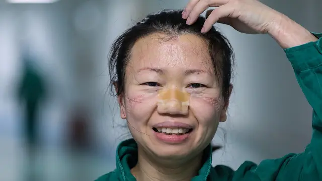 Perawat di Wuhan, China, Cao Shan saat melepaskan masker nya usai bertugas menangani pasien COVID-19 pada 17 Februari, 2020 (Photo credit: Chen Zhuo/chinadaily.com.cn)