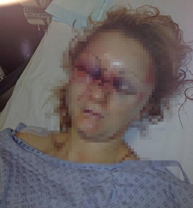 Wajah Dronfied penuh luka setelah dianiaya kekasihnya | Photo: Copyright metro.co.uk