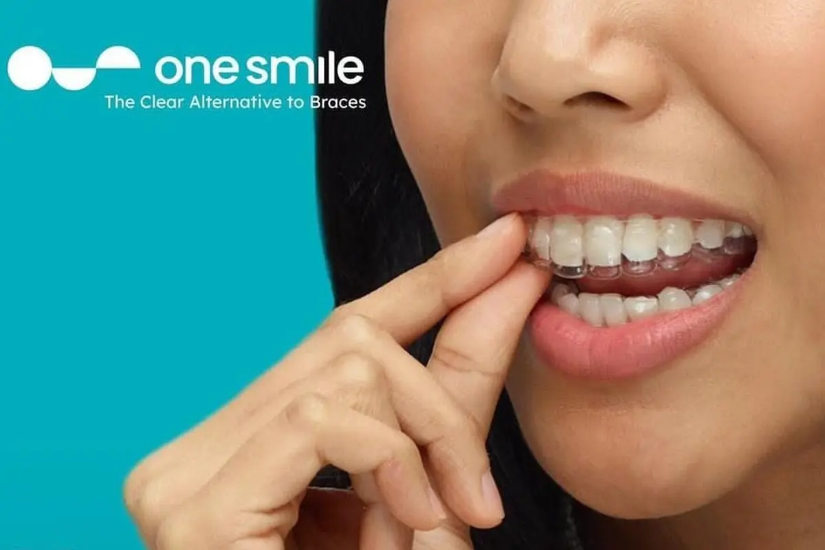 clear aligners