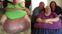 Pria ini akhirnya dioperasi setelah bertahun-tahun tumor di perutnya dikira lemak karena kegemukan.