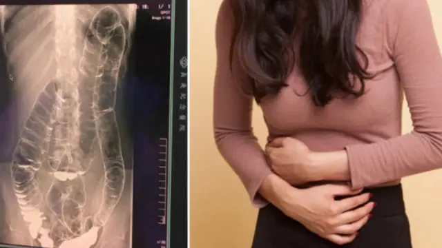 Viral Foto Rontgen Wanita Ini Sembelit Usus Sampai ke Jantung, Bikin Terkejut