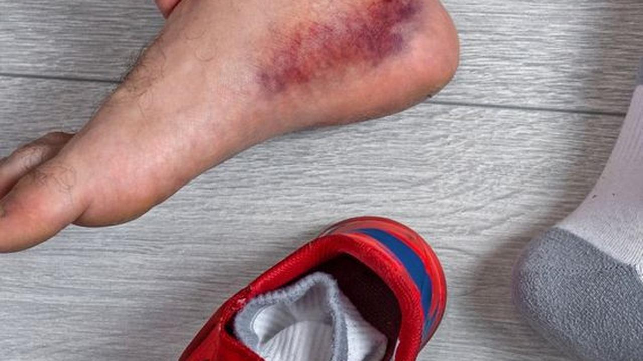 Faktor Risiko Cedera Tendon Achilles