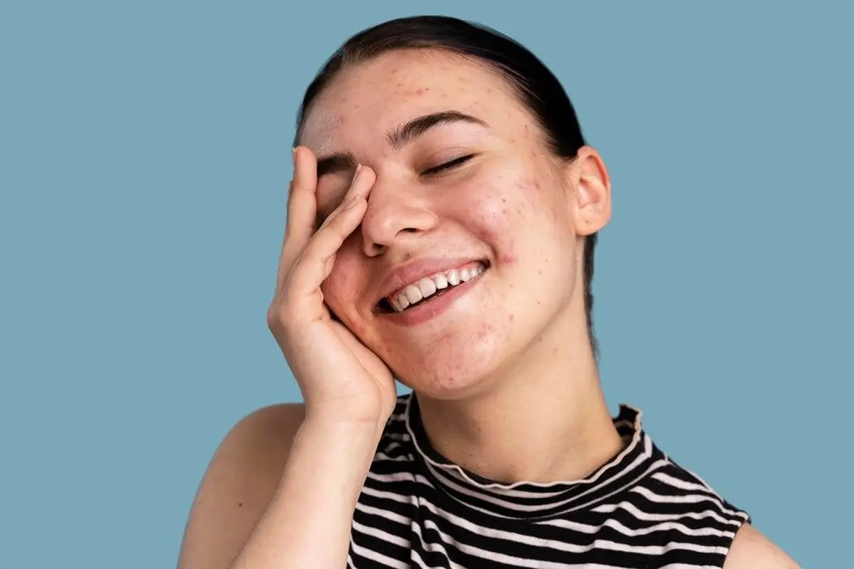 Tips untuk Kulit Berjerawat Tetap Bisa Pakai Makeup (Foto/Sumber: Freepik)
