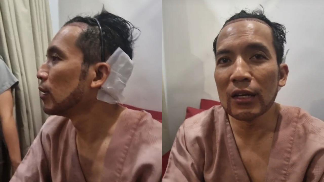 Desta Jalani Transplantasi Rambut