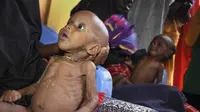  Dalam Dua Hari, 100 Orang Tewas Akibat Kelaparan di Somalia (AP)