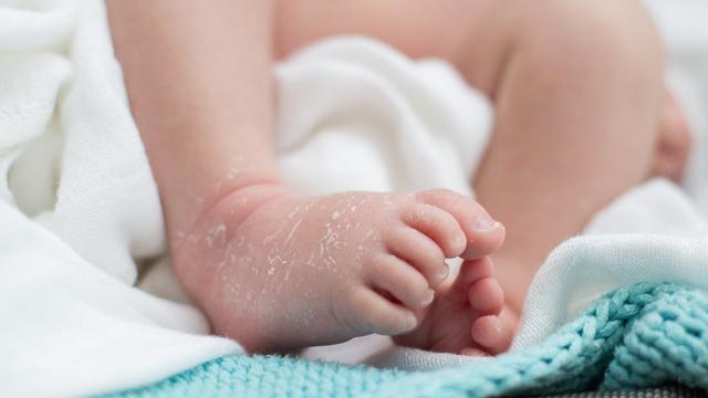 Penyakit Kulit pada Bayi