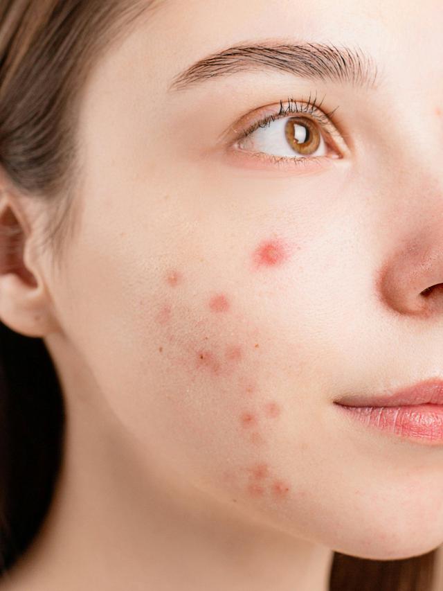 Basic Tips to Prevent and Treat Acne