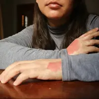 Psoriasis Vulgaris merupakan jenis psoriasis yang paling umum. (Foto: Instagram/justjo_anne)