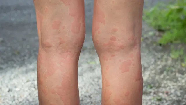 Angioedema