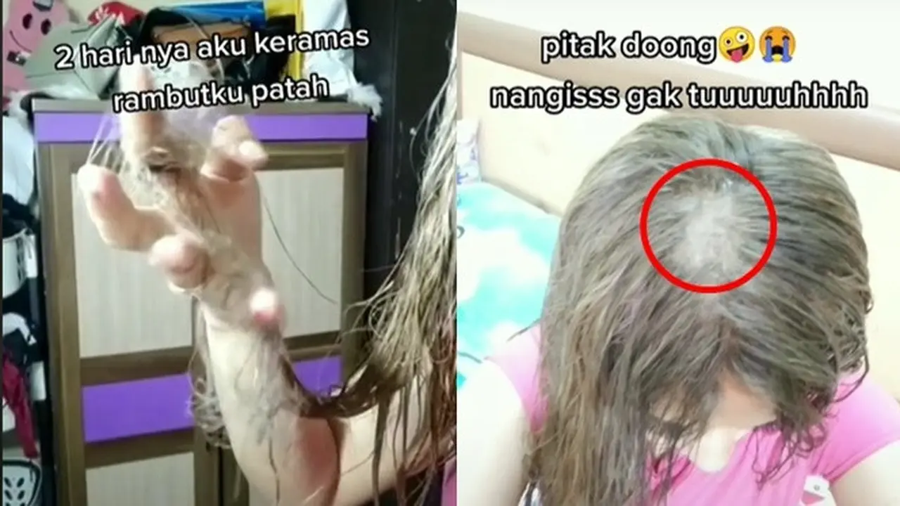 Tergiur Harga Murah di Salon, Wanita Ini Alami Rontok Parah dan Hampir Botak