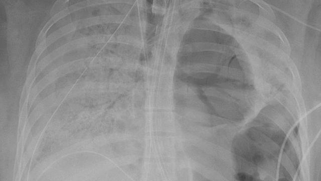 Seram, Penampakan Paru-Paru Wanita Muda yang Rusak Akibat Virus Corona