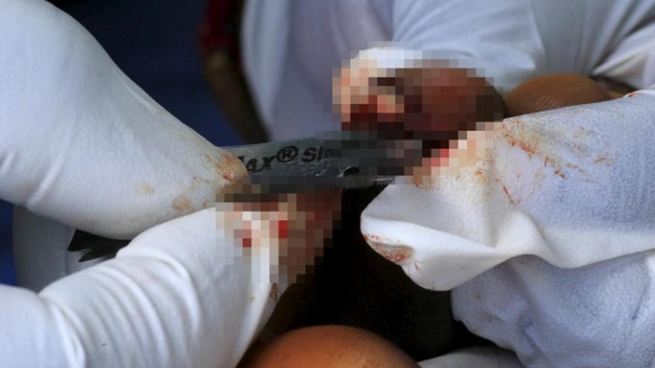 Derita warga Uganda terinfeksi kutu pengisap darah Jigger
