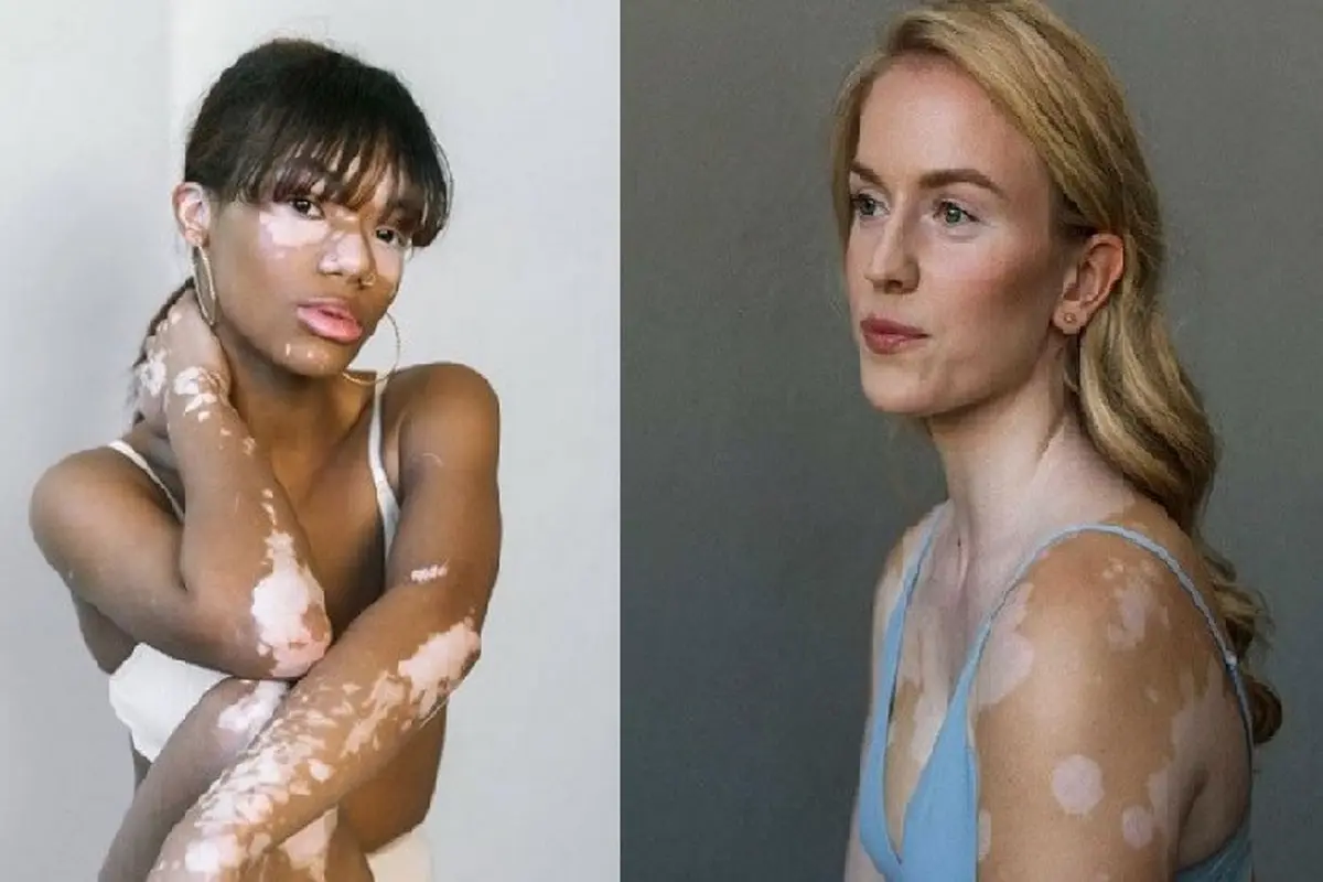 model vitiligo