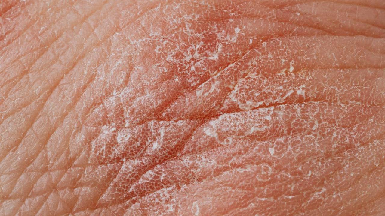 Ilustrasi Dermatitis Kontak