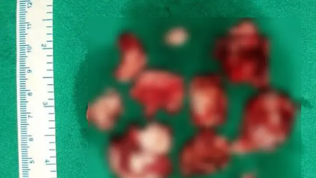 Derita Tumor Langka, Pria Ini Miliki 82 Gigi dalam Mulutnya
