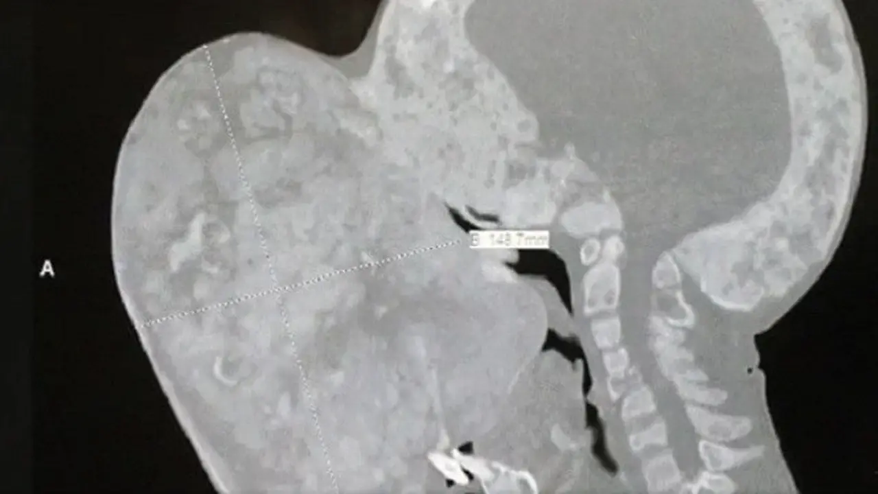 Tumor