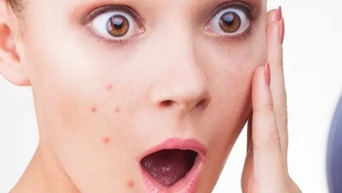 Jangan Minder, Tutupi Bekas Jerawat dengan Makeup Ini Saja
