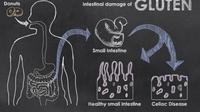 Inilah Tanda-tanda Anda Mengalami Intoleransi Gluten