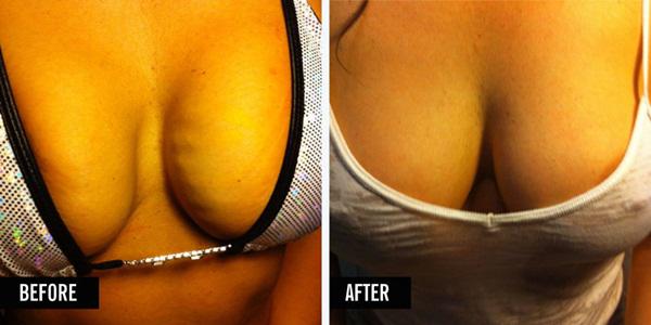 Before after breast lift/ copyright by cosmopolitan.com