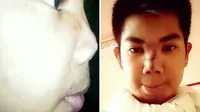 Suntikan Murah 'Vermak' Wajah Model Ini Menjadi Seperti Monster