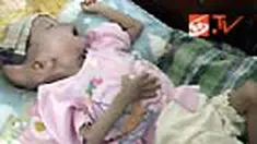 Berat tubuh Mutiara, bayi berusia satu tahun enam bulan ini tak seimbang dibanding bayi seusianya. Demam sang bayi masih tinggi mencapai 38 derajat Celcius. 