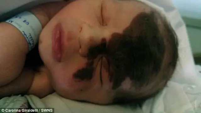 [Bintang] Punya Anak Memiliki Tanda Lahir di Wajah, yang Dilakukan Ibu Ini Bikin Banyak Orang Terharu