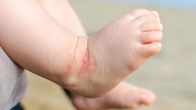 Fakta Seputar Dermatitis Atopik (sumber: iStockphoto)