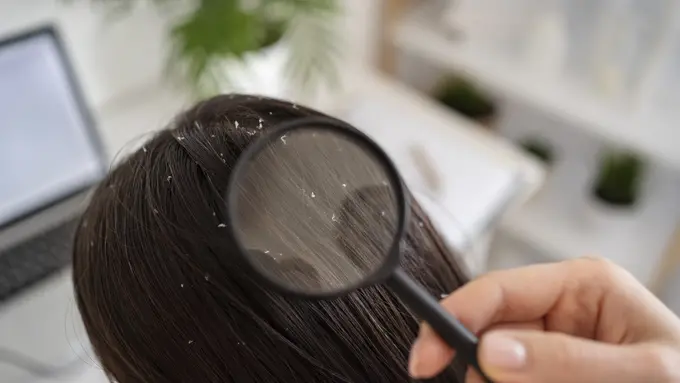 penyebab umum ketombe