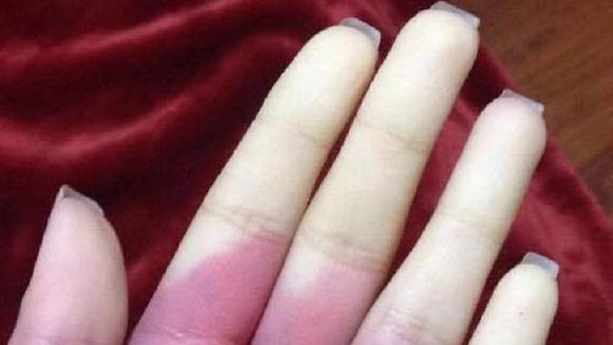 Penyakit Raynaud. (Wikimedia/Creative Commons)