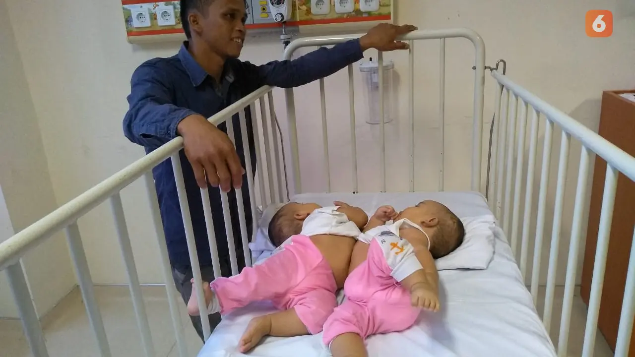 Bayi Kembar Siam